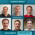 Turkey's Best Hair Transplant Clinics in 2026: A Surgeon-by-Surgeon, Clinic-by-Clinic Breakdown