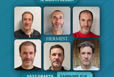 Turkey's Best Hair Transplant Clinics in 2026: A Surgeon-by-Surgeon, Clinic-by-Clinic Breakdown