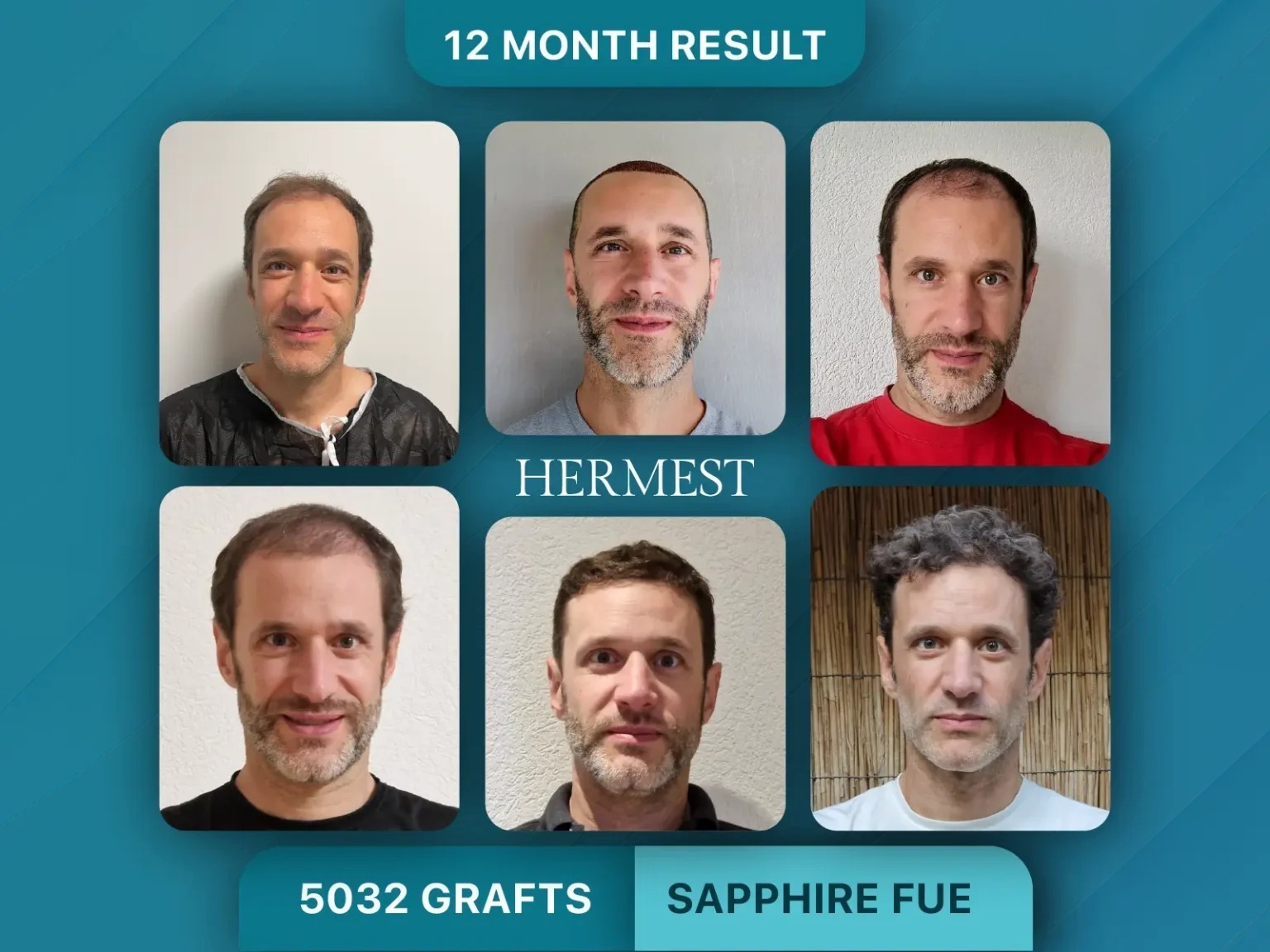 Turkey's Best Hair Transplant Clinics in 2026: A Surgeon-by-Surgeon, Clinic-by-Clinic Breakdown