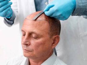 Turkey's Best Hair Transplant Clinics in 2026