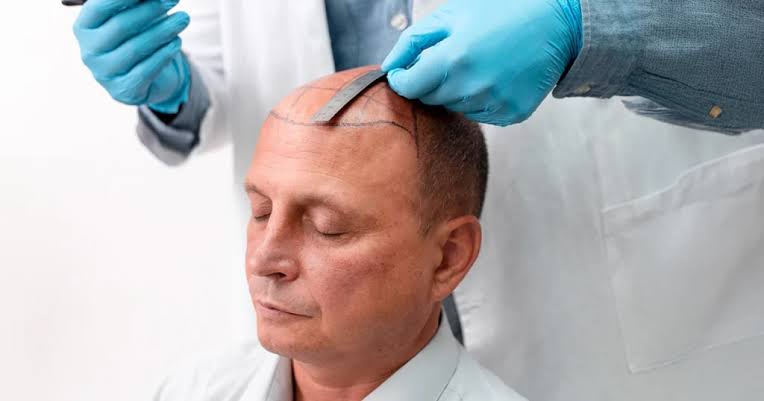Turkey's Best Hair Transplant Clinics in 2026