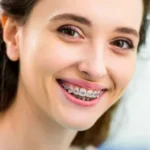 Adult Braces — Straighten Your Smile No Matter the Age.